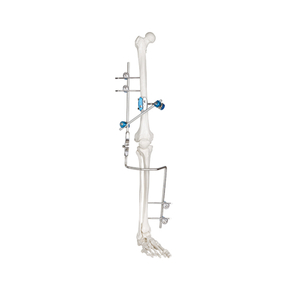 Articulación de la rodilla fijador externo
