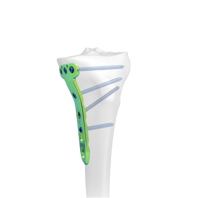 Placa de bloqueo para osteotomía tibial proximal medial