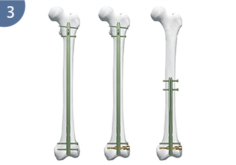 Experto R/AFN. Uña femoral retrógrada /antes de