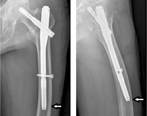 Radiografía-muestra-la-punta-del-PFNA-II-contra-la-pared-lateral-en-pacientes-ancianos-con-un_副本