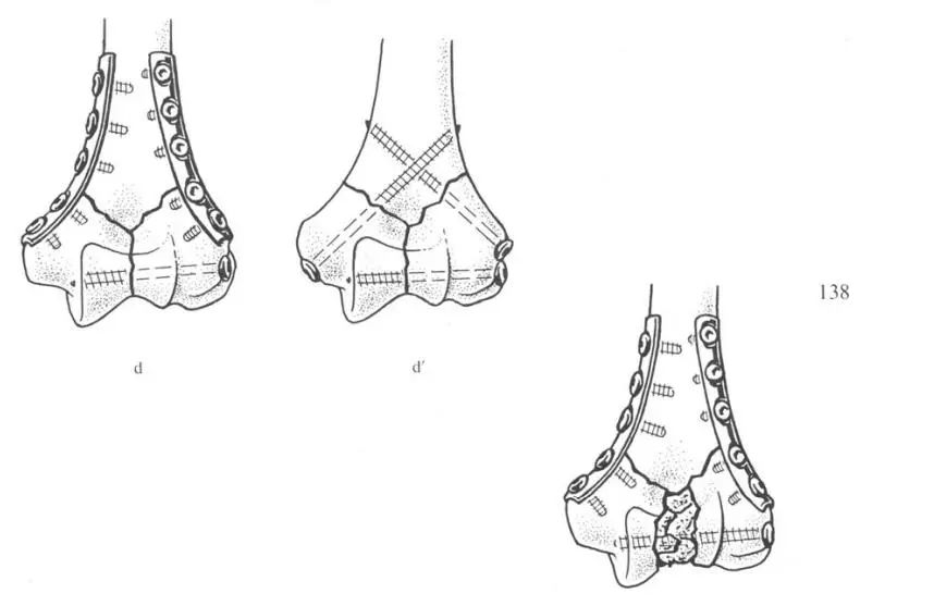 húmero distal