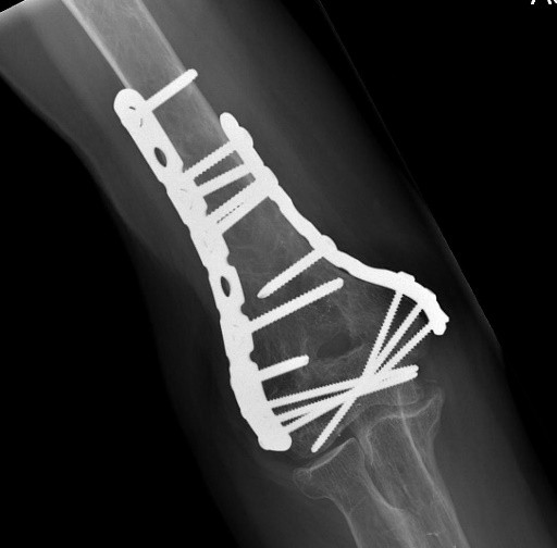 ¿Cómo se arregla una fractura de húmero distal?