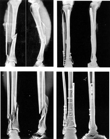 Fractura del eje tibial