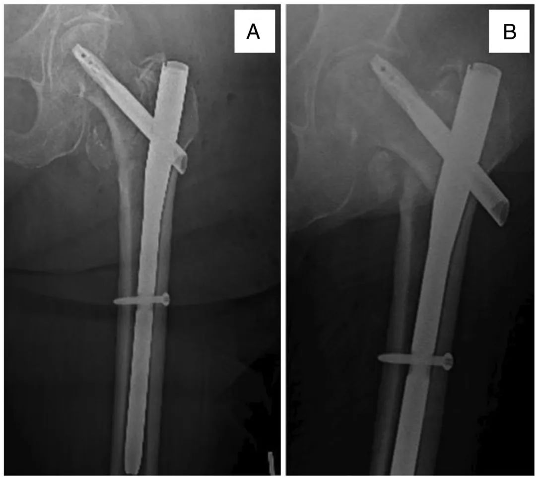 ¿Qué sucede si falla la fijación interna de una fractura entre rotadores?