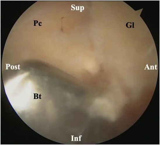 Tratamiento artroscópico de la inestabilidad posterior del hombro