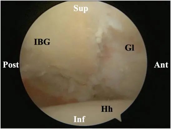 Tratamiento artroscópico de la inestabilidad posterior del hombro