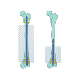 Experto Invertido Intertanes femorales Intramedular Nail