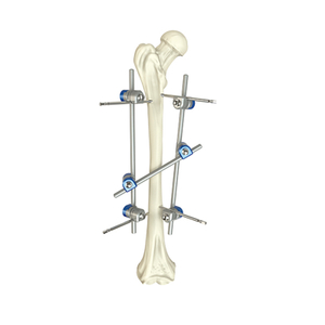 Femoral Femoral Femoral Faxator