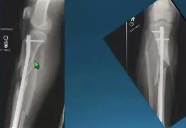 intramedular tibial