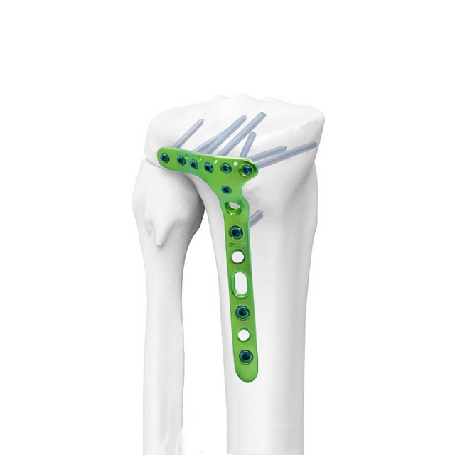 Placa de bloqueo tibial lateral distal II