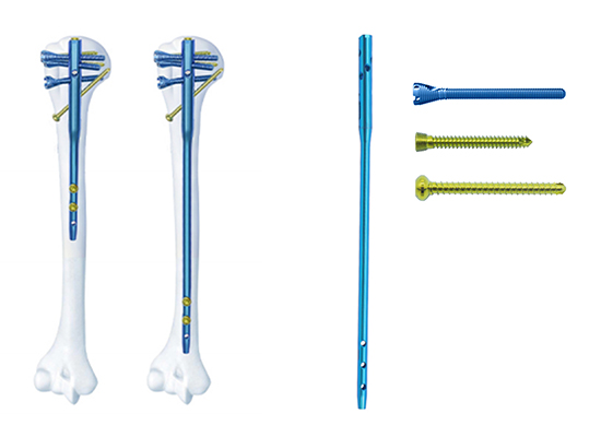 Clavo intramedular humeral multibloqueo-czmeditech