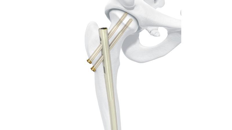 Clavo intramedular para reconstrucción femoral