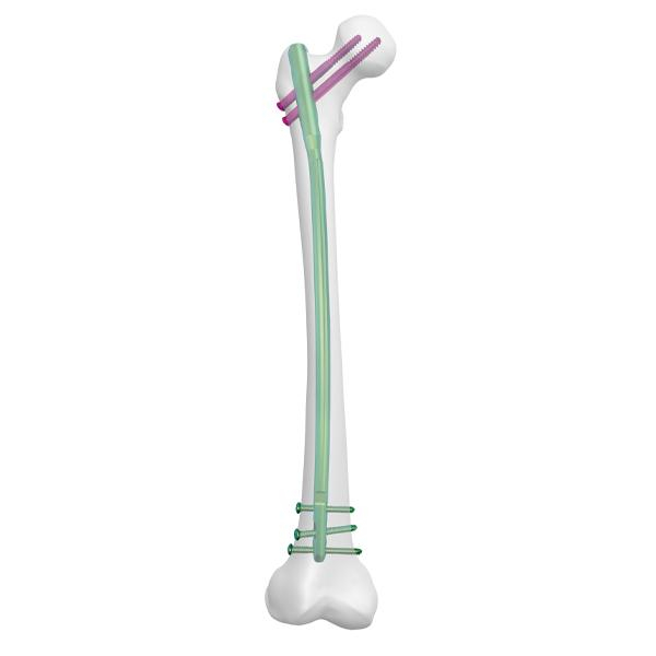 Clavo femoral experto