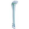 Expert Tibia Clavo