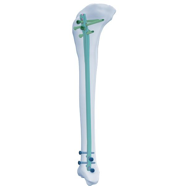 Expert Tibia Clavo
