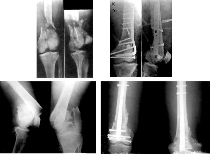 Fractura femoral distal
