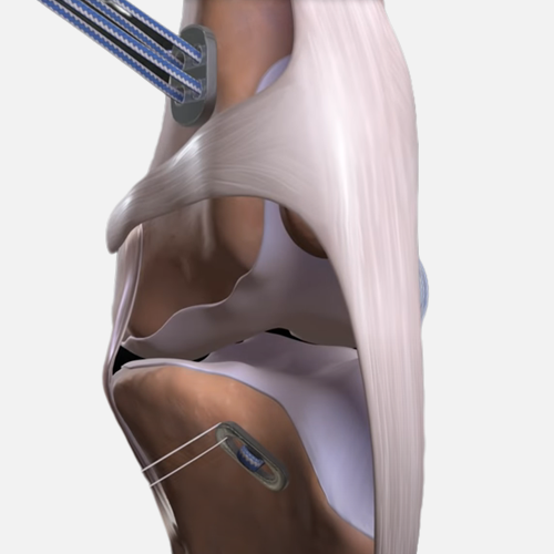 Sistema de ligamentos artificiales