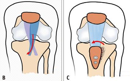 tratamiento inestabilidad de la articulación femororrotuliana en niños