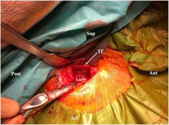 Tratamiento artroscópico de la inestabilidad posterior del hombro
