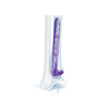 VA Placa de bloqueo de tibia lateral distal