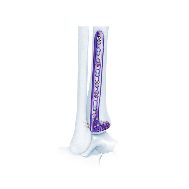 VA Placa de bloqueo de tibia lateral distal