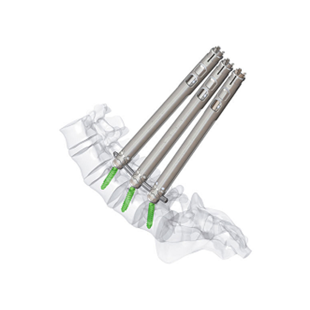 5.5 Tornillo pedical mínimamente invasivo
