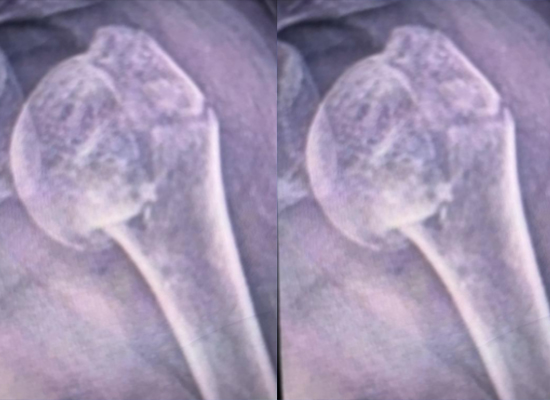 fractura-de-cabeza-humeral-preoperatoria-rayos-x-czmeditech