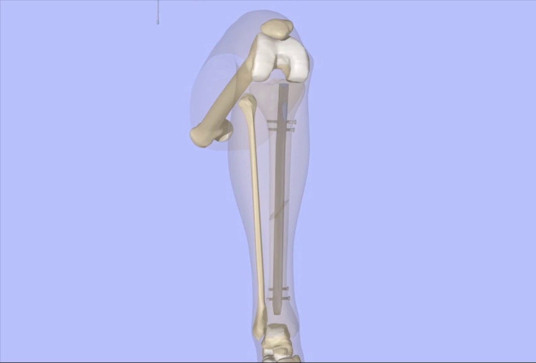 Clavo intramedular tibial: una solución fiable para las fracturas tibiales