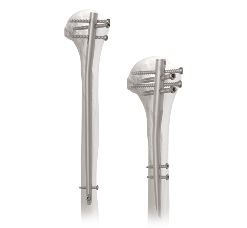 humeral_nail_system_0-xlarge