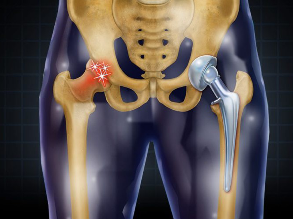 Scenarios for use of the femoral stem Escenarios de uso del vástago femoral
