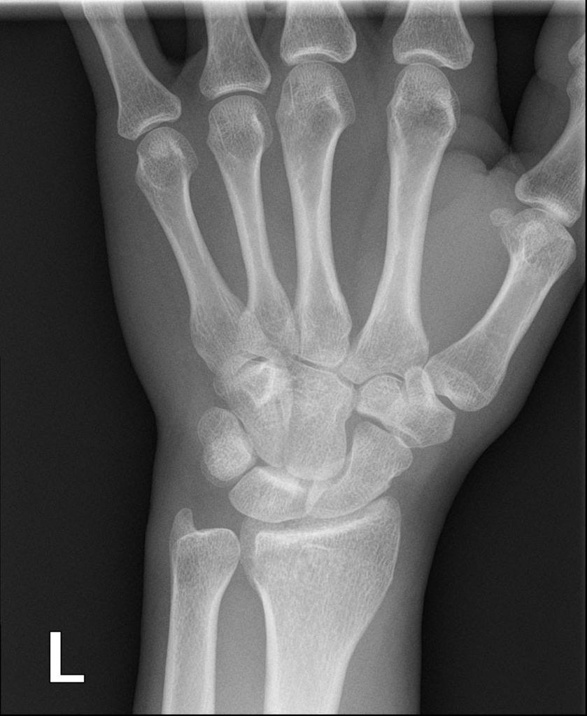 Nuevas técnicas para la fijación con placa volar de fracturas de radio distal