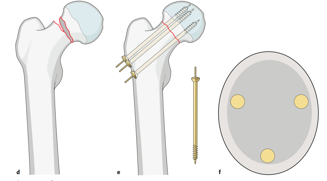 Amplio conocimiento de los pros y los contras del tratamiento de fijación con tornillos huecos para las fracturas del cuello femoral