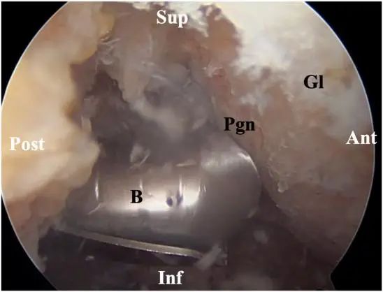 Tratamiento artroscópico de la inestabilidad posterior del hombro