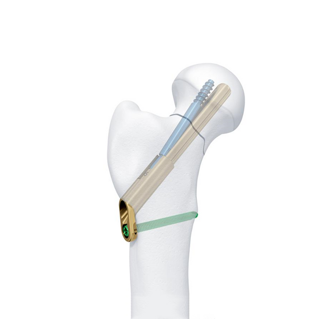 FNS (Sistema de cuello femoral)