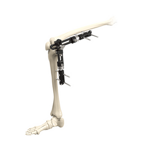 Fijador externo de la articulación de la rodilla