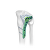 Placa de bloqueo tibial lateral proximal-II