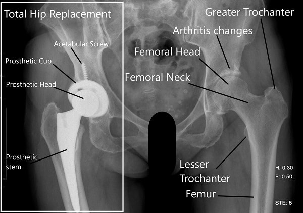 Dónde utilizar el mango femoral