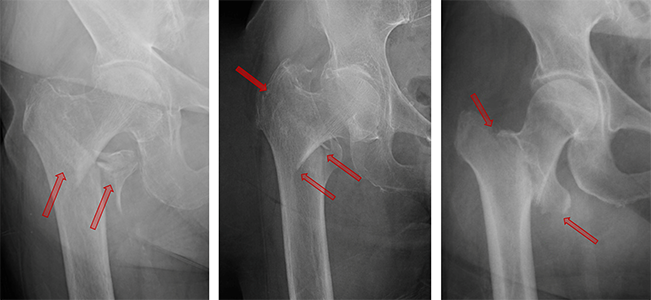 ¿Cuáles de las siguientes técnicas se utilizan para reparar las fracturas intertrocantéricas?