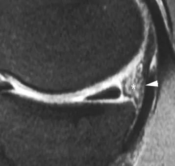Desprendimiento del cuerno posterior del menisco