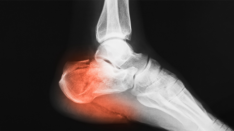 ¿Cómo se trata una fractura de calcáneo?