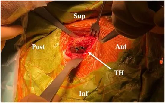 Tratamiento artroscópico de la inestabilidad posterior del hombro