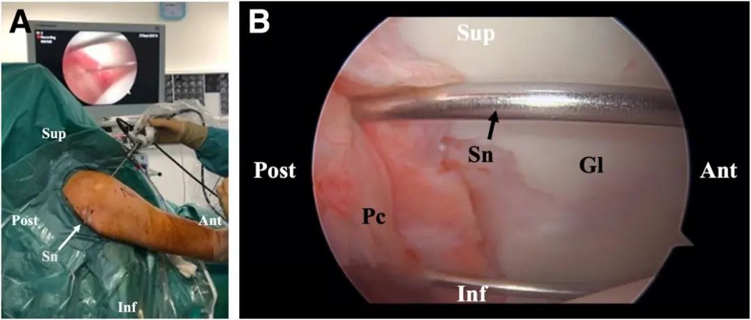 Tratamiento artroscópico de la inestabilidad posterior del hombro