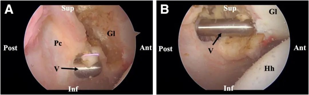Tratamiento artroscópico de la inestabilidad posterior del hombro
