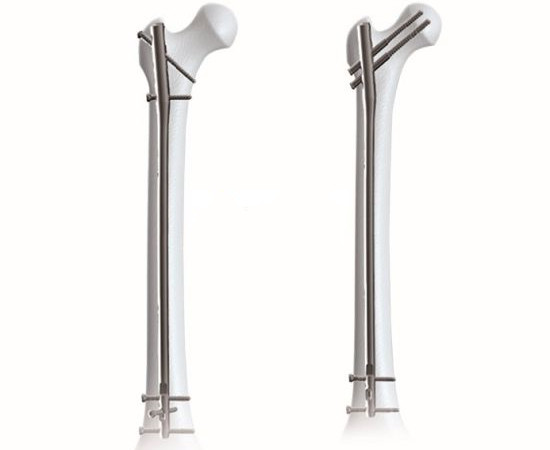 Clavo intramedular femoral Expert