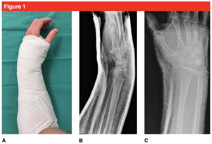 Fractura de radio distal