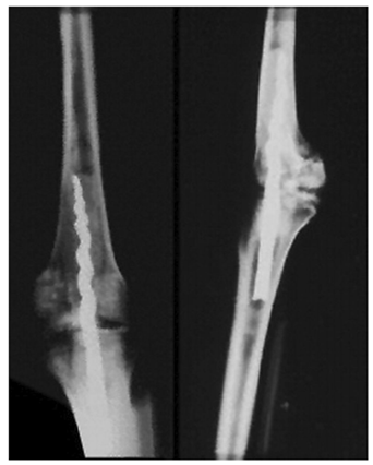 Los antiguos egipcios utilizaron por primera vez un dispositivo intramedular similar a un clavo.Es improbable que existiera la atención de fracturas quirúrgicas complejas hace tantos años.Lo cierto, sin embargo, es que los antiguos egipcios tenían grandes técnicas de embalsamamiento derivadas de su creencia en la resurrección del cuerpo en el más allá.Este fue el caso de la momia llamada Usermontu encontrada en la tumba de Tutankamón, donde se insertó un clavo roscado entre el fémur y la tibia para estabilizar la articulación de la rodilla (como en la Figura 2).Los arqueólogos especulan que la momia dentro del sarcófago no era el propio Usermontu, sino otra persona que fue reemplazada por antiguos ladrones de tumbas en el año 600 a.2000 años después, Bernardino de Sahagún, antropólogo de la expedición de Hernando Cortés, reportó el primer uso de enclavado intramedular en un paciente vivo en México.En 1524, fue testigo de cómo un cirujano de huesos azteca (llamado 'Tezalo') realizaba una osteotomía con un bisturí de obsidiana y luego insertaba una varilla de resina en la cavidad medular para estabilizar la fractura.Debido a la falta de técnicas quirúrgicas y antisépticos adecuados, estos procedimientos tenían una alta tasa de complicaciones y una alta tasa de mortalidad.