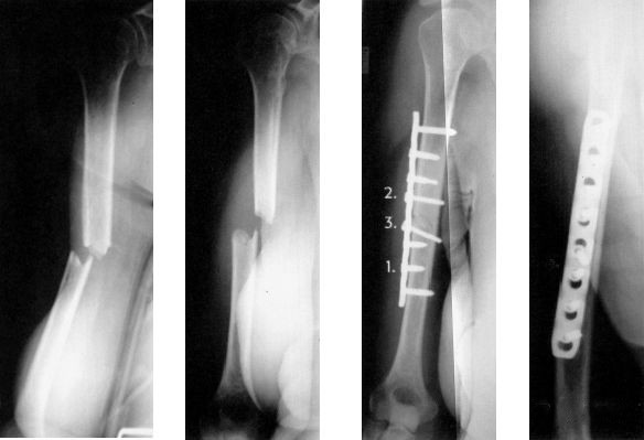 Fractura de diáfisis humeral