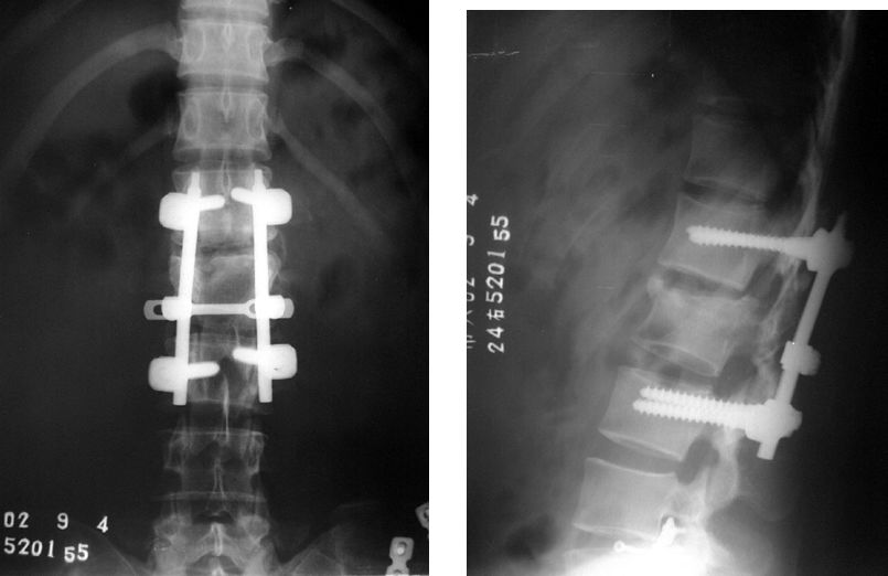 fractura de columna
