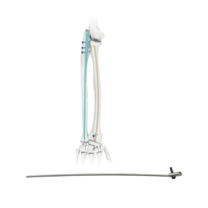 Radio Intramedular Nail