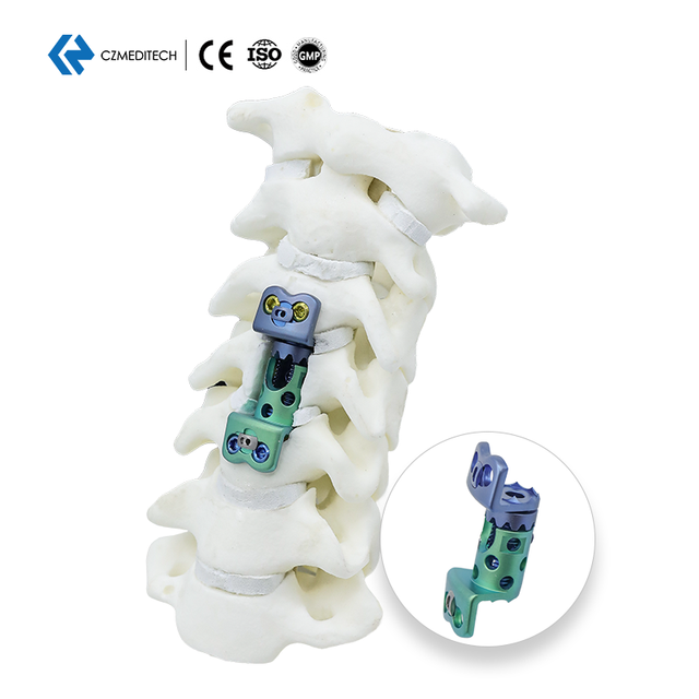 Jaula de malla de titanio expandible cervical